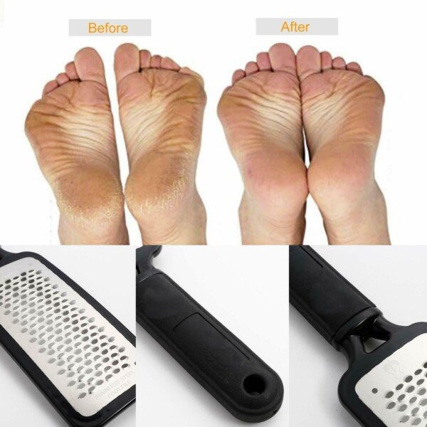 Foot Rasp File Callus Remover Pedicure Tool Dead Hard Skin Scraper Scrubber Tool - Image 9